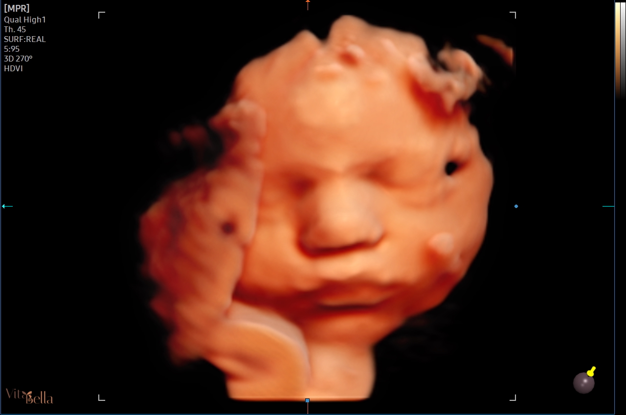 Voorbeeld 3 voor: gedetailleerde 3D echo van het babyprofiel als input voor een realistische Speejers babyvisualisatie
