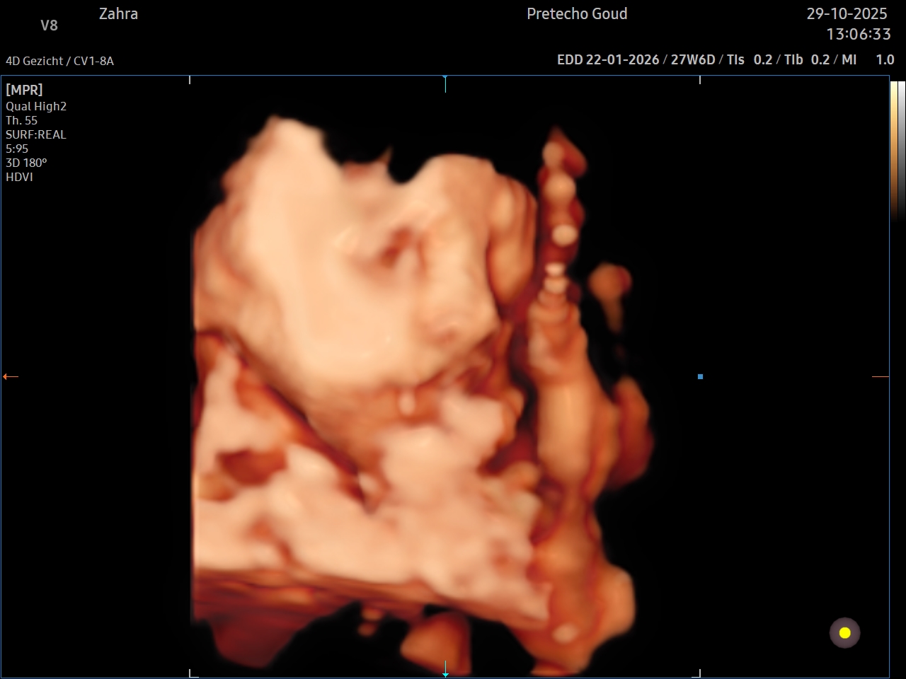 Voorbeeld 4 voor: 3D echo close-up van babygezicht gebruikt als bronmateriaal voor een 6D echo resultaat